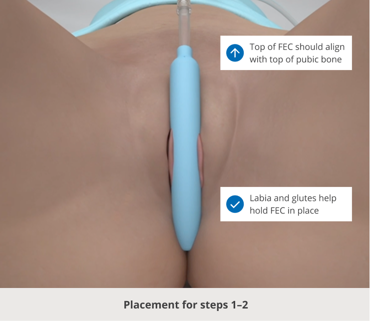 Top of FEC should align with top of pubic bone | Labia and glutes help hold FEC in place